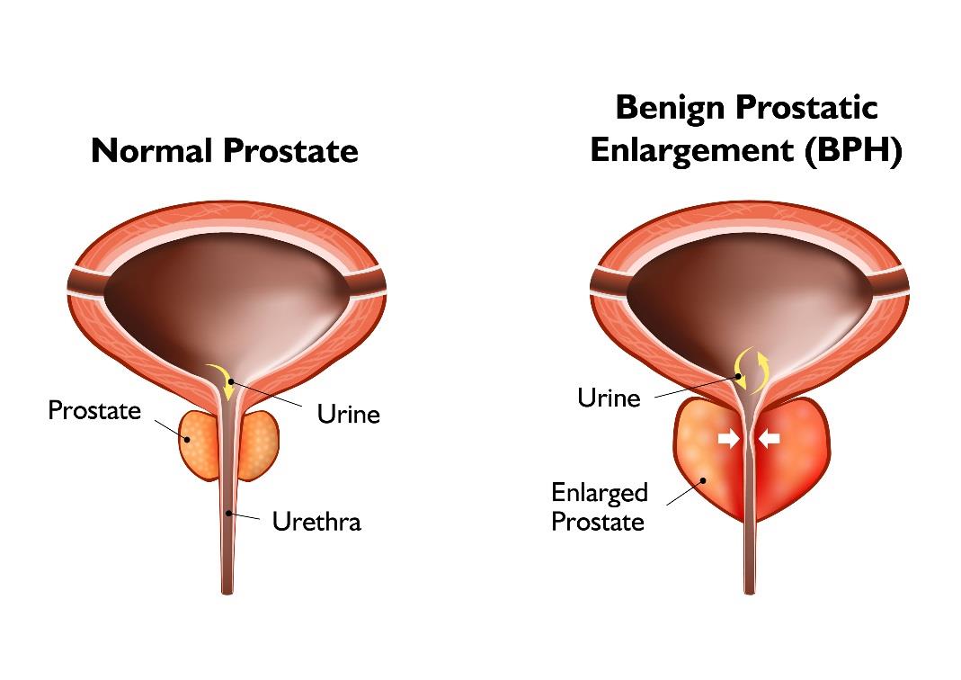 Prostate Hyperplasia 1- 2)