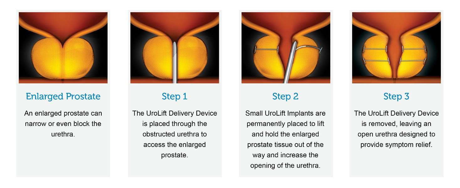 How Does The UroLift® System Work?
